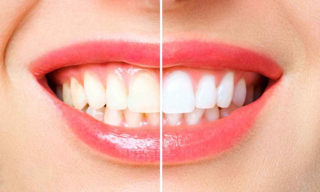 Teeth Guide Online Blogging: Ultimate Guide to Teeth Whitening Techniques