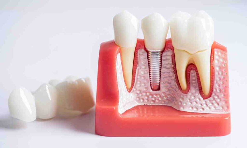 Local Dentition Blog, Online Implant Teeth Guide Blogging